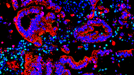 Bild zur Presseinformation "Wie das Immunsystem Bauchspeicheldrüsenkrebs beeinflusst: UMG-Forschungsgruppe entschlüsselt neue Mechanismen"